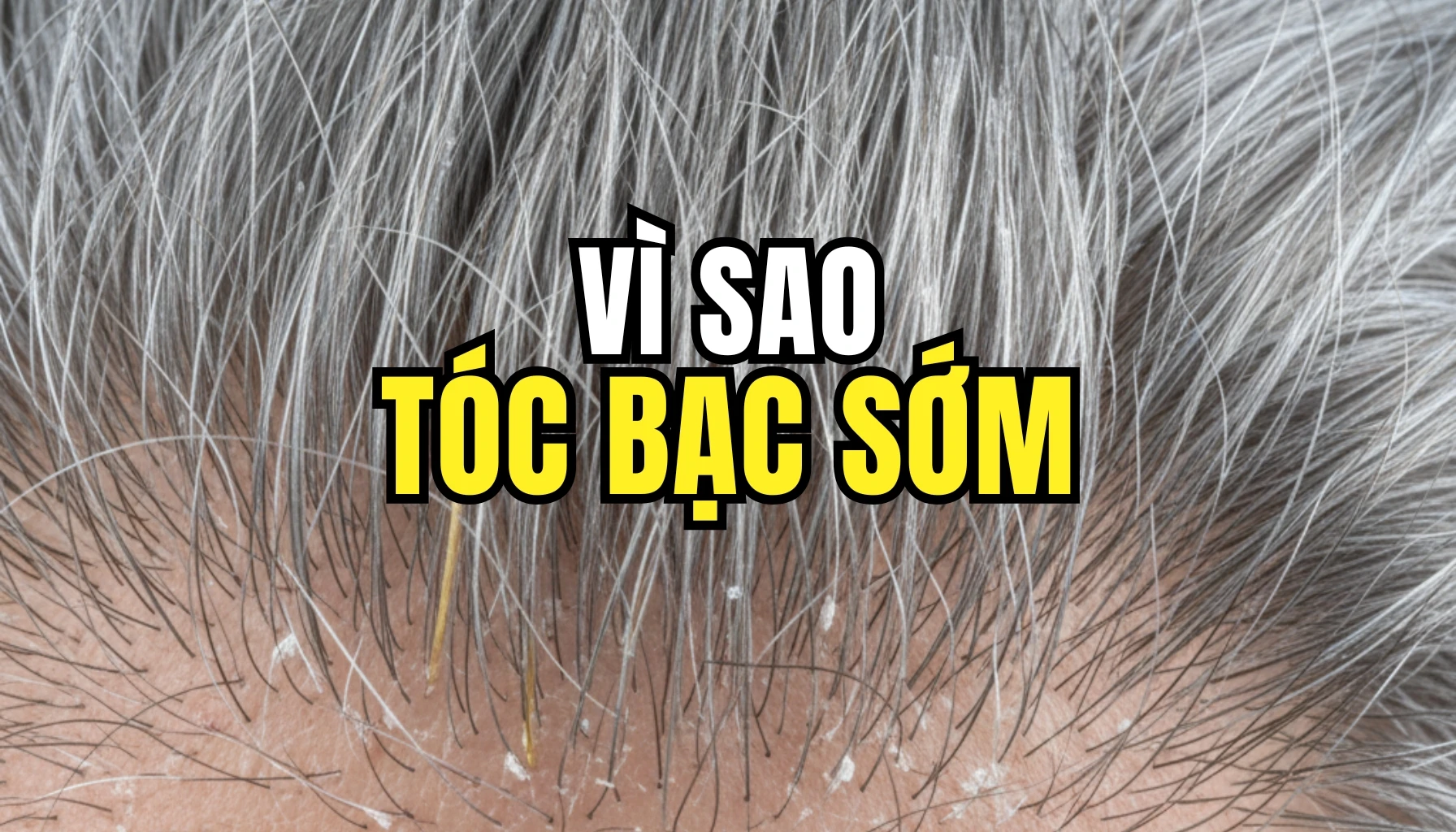 Nguyên nhân vì sao tóc bạc sớm? Bật mí sự thật bạn nên biết